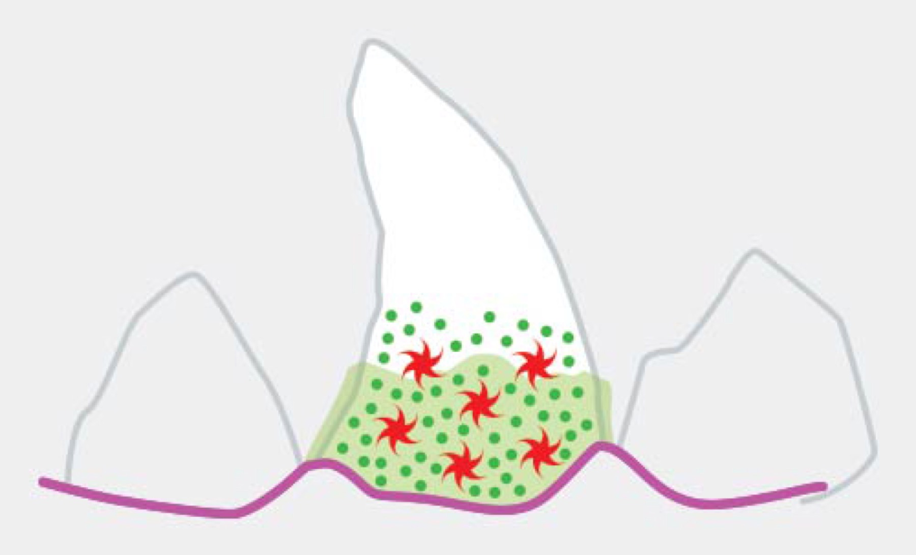 Illustration: plaque hardening into calculus (tartar)